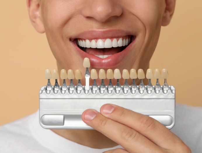 Déroulement d’un traitement par facettes