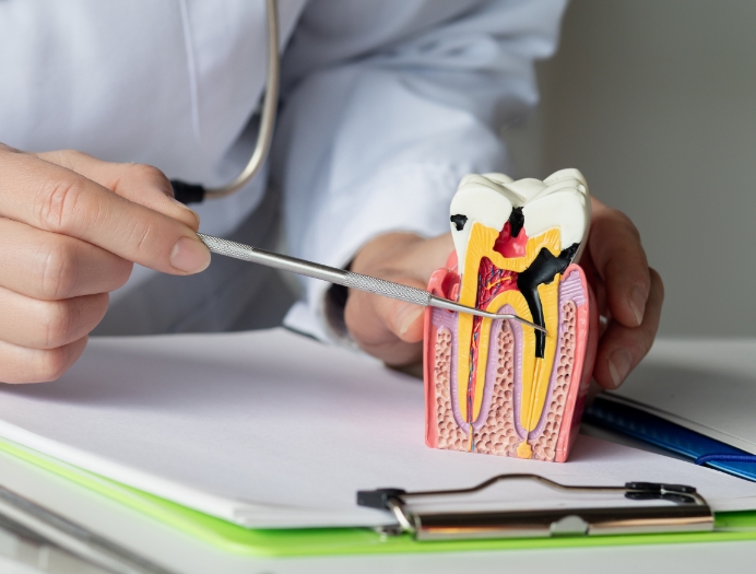 Pourquoi le traitement de canal devient-il nécessaire Pourquoi le traitement de canal devient-il nécessaire