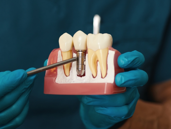 Pourquoi est-il avantageux d’avoir recours à une restauration sur implants