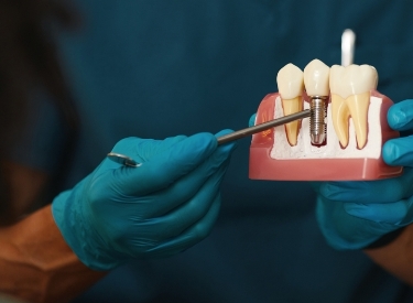 Restaurations sur implants Restaurations sur implants